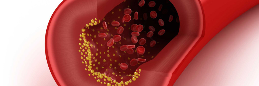 8 عامل موثر در افزایش کلسترول خون