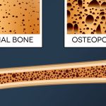 تقویت استخوان – پیشگیری از پوکی استخوان