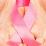 درمان سرطان سینه و نقش رژیم غذایی در آن