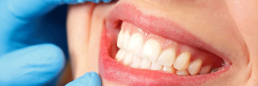 سرطان دهان و راه های پیشگیری از آن