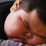عوارض چاقی در کودکان و نوجوانان